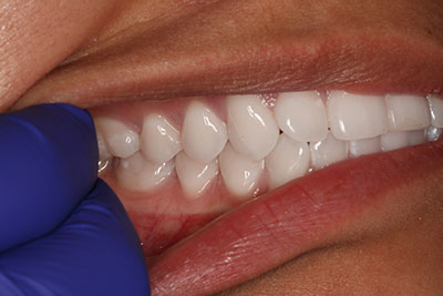 Virtual Consultation Front Teeth